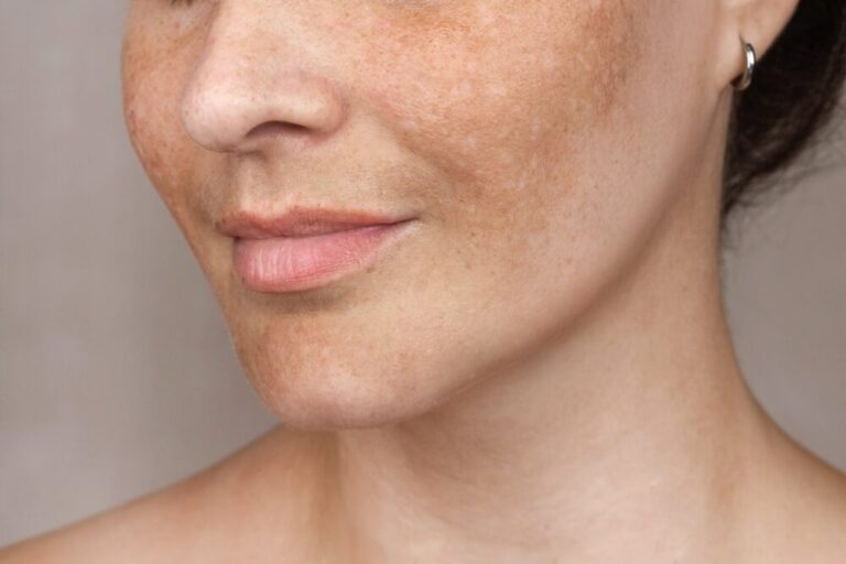 Are Gentle Procedures Suitable for Sensitive Melasma-Prone Skin