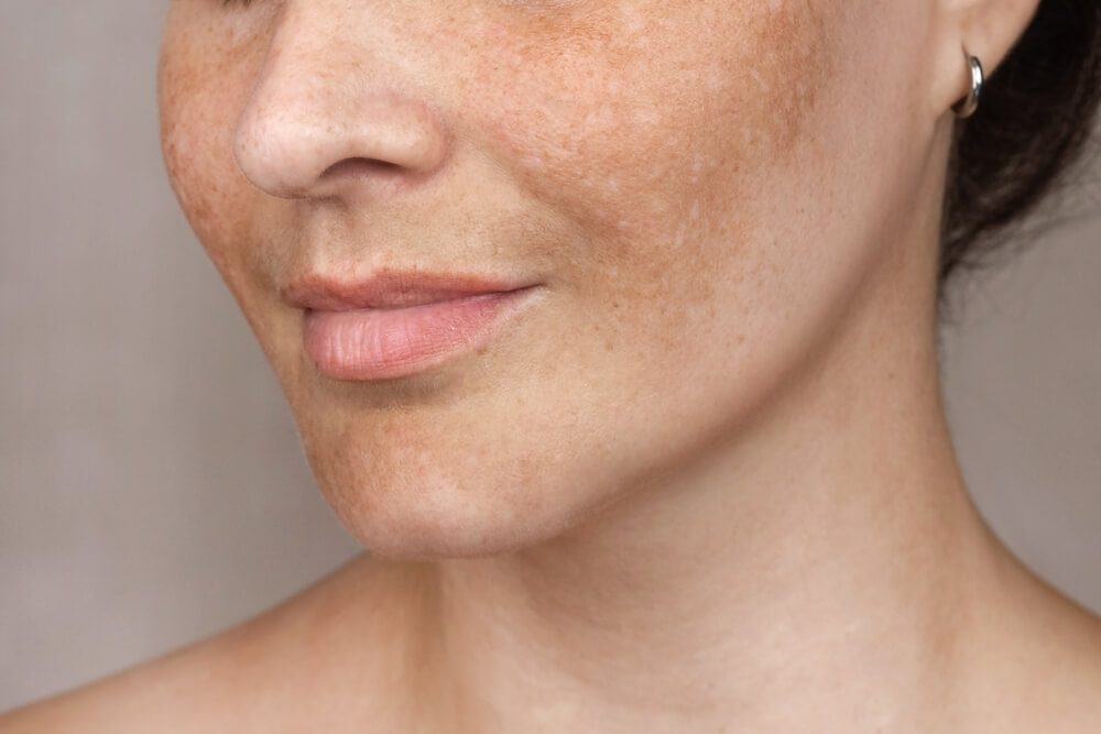 Are Gentle Procedures Suitable for Sensitive Melasma-Prone Skin